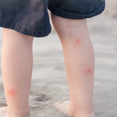 Stop Mosquito Bite Itchies in Their Tracks!