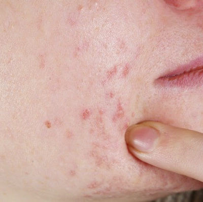 Three foods that cause acne and natural remedies to help it